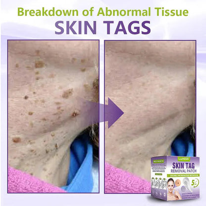 ✅Lumivo® Soluble Microneedle Botanical Skin Tag Removal Patch