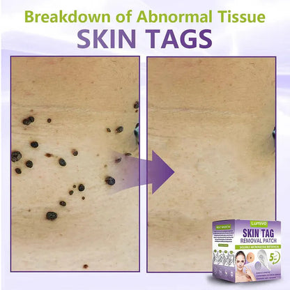 ✅Lumivo® Soluble Microneedle Botanical Skin Tag Removal Patch
