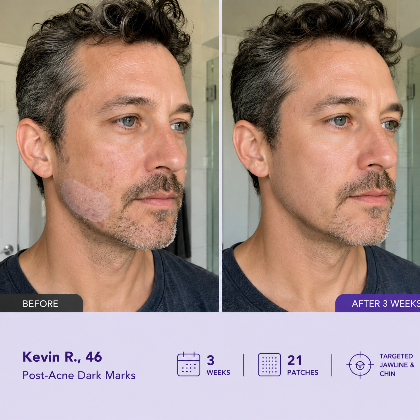 Lumivo Dark Spot Removal Patch|Nano Microneedle Technology · Visible Results in 7 Days