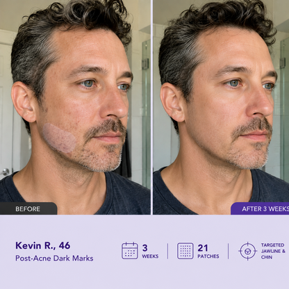 Lumivo Dark Spot Removal Patch|Nano Microneedle Technology · Visible Results in 7 Days