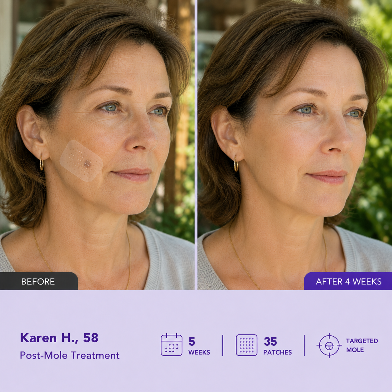 Lumivo Dark Spot Removal Patch|Nano Microneedle Technology · Visible Results in 7 Days