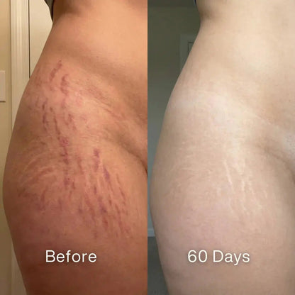 🏆#1 Best Seller ⏰ Scar Renewal - Advanced Medical Silicone