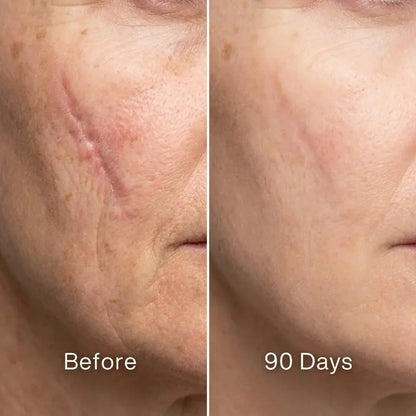 🏆#1 Best Seller ⏰ Scar Renewal - Advanced Medical Silicone