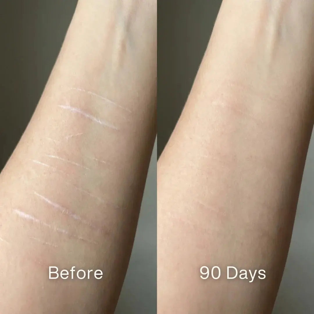 🏆#1 Best Seller ⏰ Scar Renewal - Advanced Medical Silicone