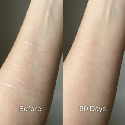 🏆#1 Best Seller ⏰ Scar Renewal - Advanced Medical Silicone