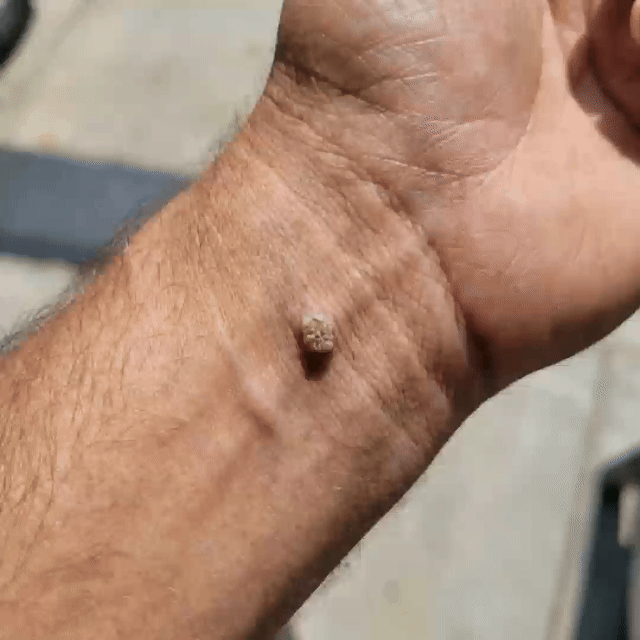 ✅Lumivo® Soluble Microneedle Botanical Skin Tag Removal Patch