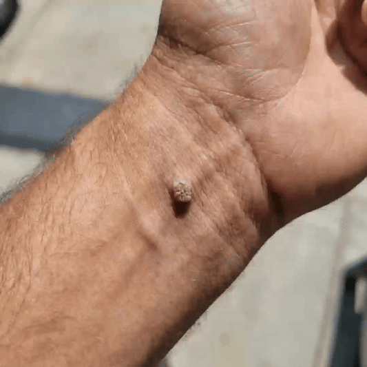 ✅Lumivo® Soluble Microneedle Botanical Skin Tag Removal Patch