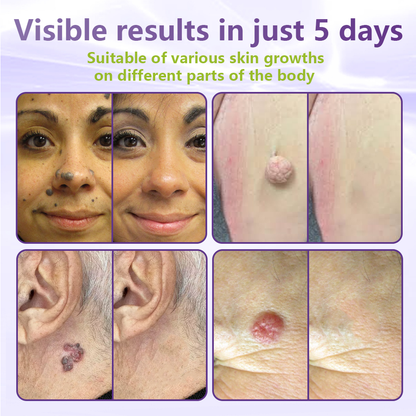 ✅Lumivo® Soluble Microneedle Botanical Skin Tag Removal Patch