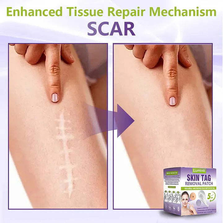 ✅Lumivo® Soluble Microneedle Botanical Skin Tag Removal Patch