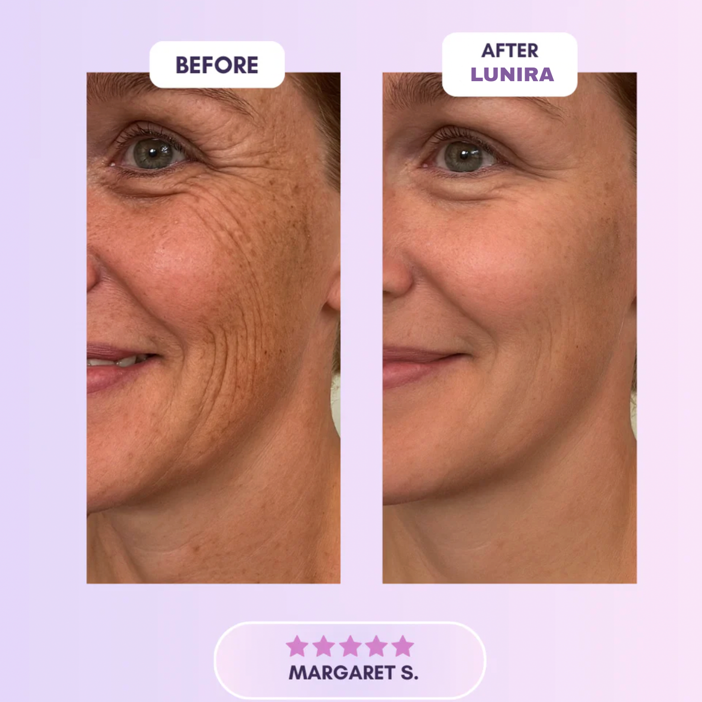 Final 3 Hours: 60%OFF🔥 Silicone Wrinkles Patch