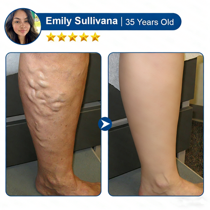 Lumivo® 𝑽𝗲𝗶𝙣 𝘾𝐨𝐧𝘁𝗼𝙪𝙧 𝙈𝙞𝐜𝐫𝒐𝒏𝒆𝗲𝗱𝗹𝙚 𝙋𝙖𝐭𝐜𝒉 𝒘𝒊𝘁𝗵 𝗔𝙙𝙫𝙖𝙣𝙘𝐞𝐝 𝐃𝒊𝒐𝒔𝗺𝙞𝐧 & 𝑯𝒆𝘀𝗽𝗲𝙧𝙞𝙙𝙞𝐧 𝐃𝒆𝒍𝒊𝒗𝗲𝗿𝙮🌿𝟕-𝐃𝐚𝐲 𝐕𝐢𝐬𝐢𝐛𝐥𝐞 𝐑𝐞𝐬𝐮𝐥𝐭𝐬 𝐟𝐨𝐫 𝐕𝐚𝐫𝐢𝐜𝐨𝐬𝐞 𝐕𝐞𝐢𝐧𝐬