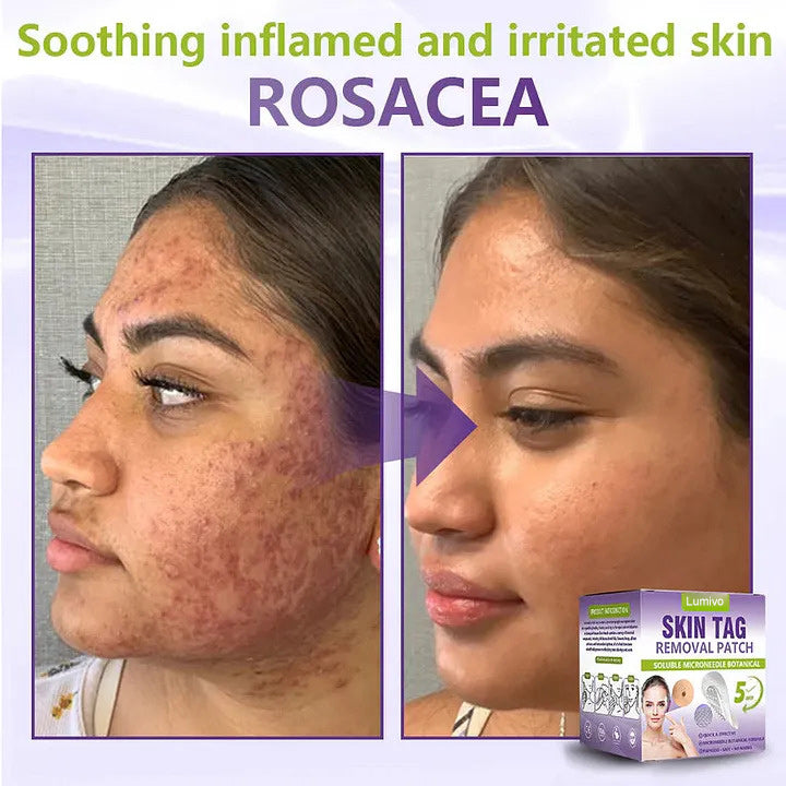 ✅Lumivo® Soluble Microneedle Botanical Skin Tag Removal Patch