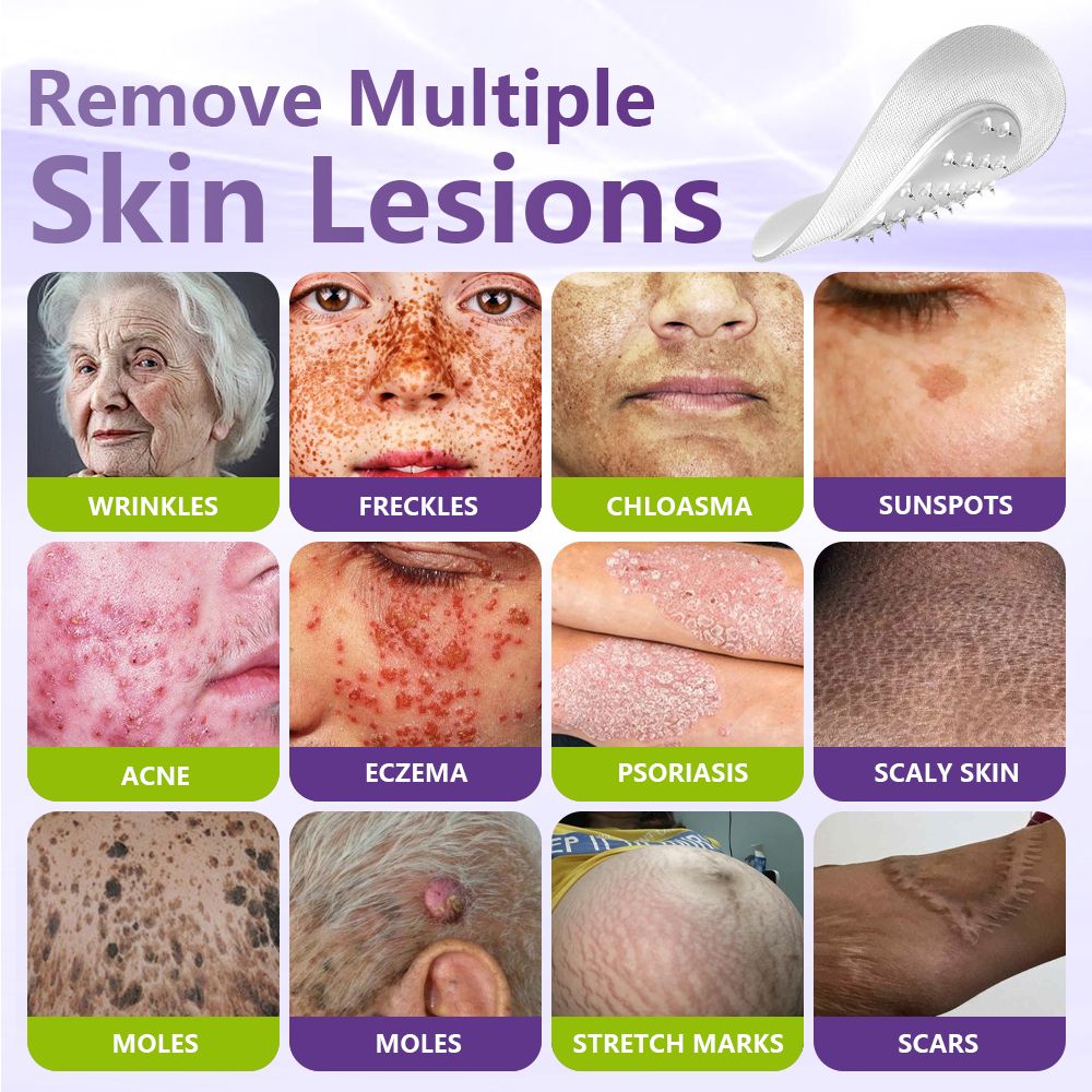 ✅Lumivo® Soluble Microneedle Botanical Skin Tag Removal Patch