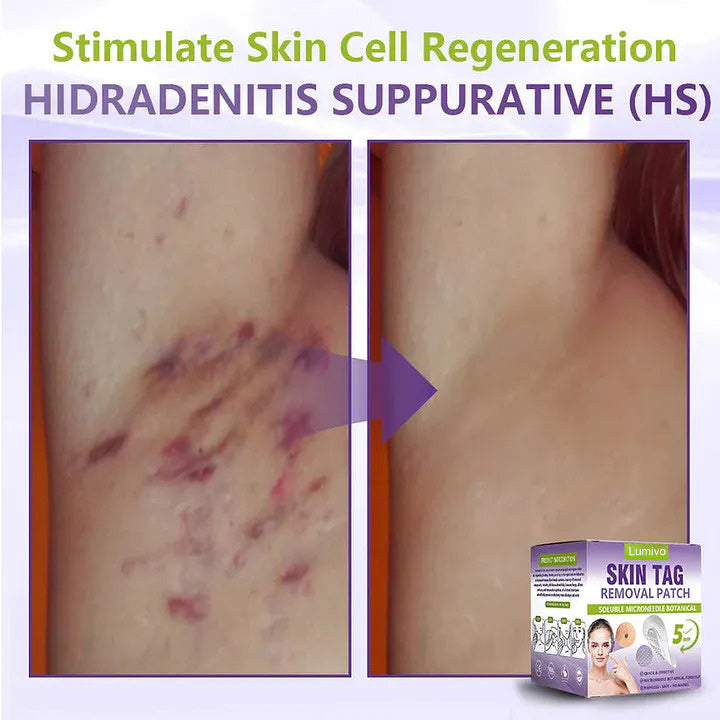 ✅Lumivo® Soluble Microneedle Botanical Skin Tag Removal Patch