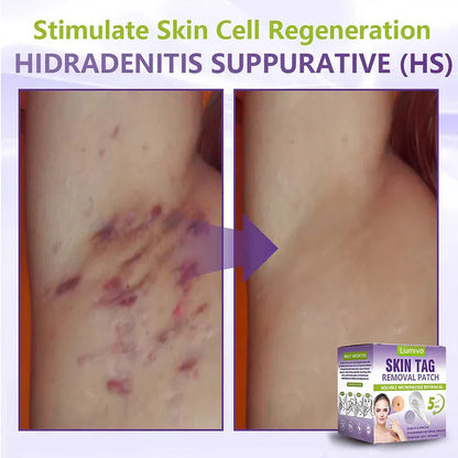 ✅Lumivo® Soluble Microneedle Botanical Skin Tag Removal Patch