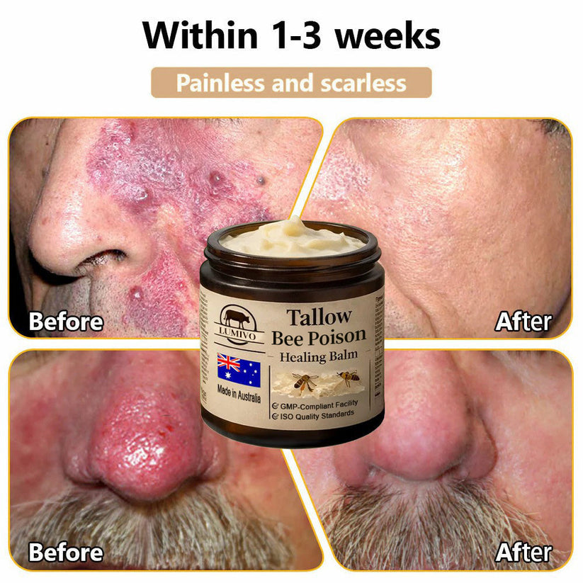 【70% OFF Wraps Up Today】LUMIVO® 🐄Tallow Bee Poison Healing Balm（Sorts Out Spots, Wrinkles & Knackered Skin — Steroid-Free）