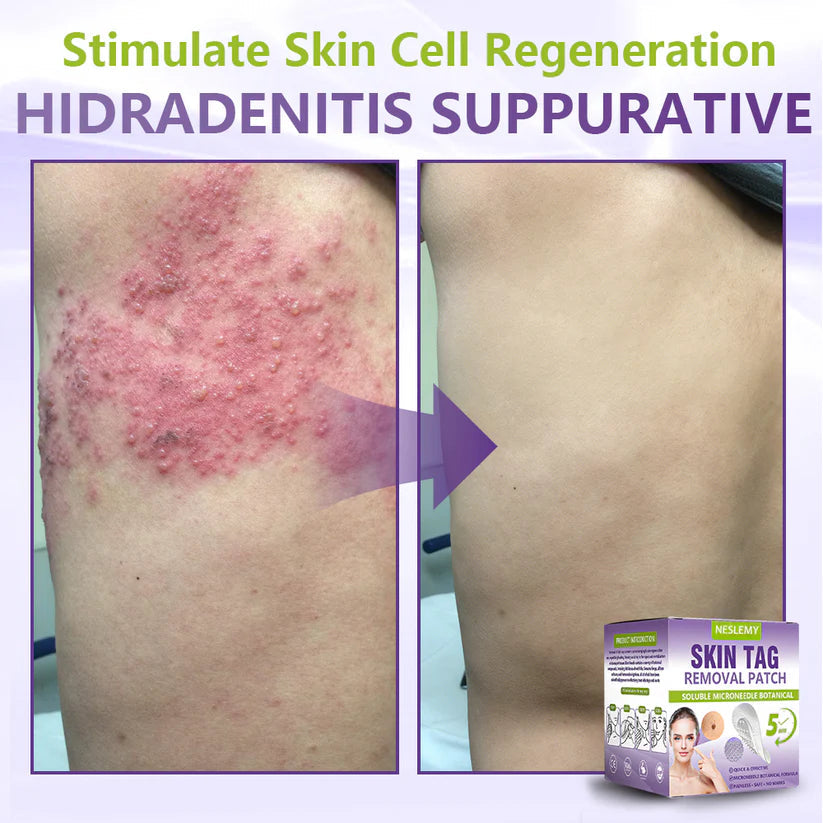 ✅Lumivo® Soluble Microneedle Botanical Skin Tag Removal Patch