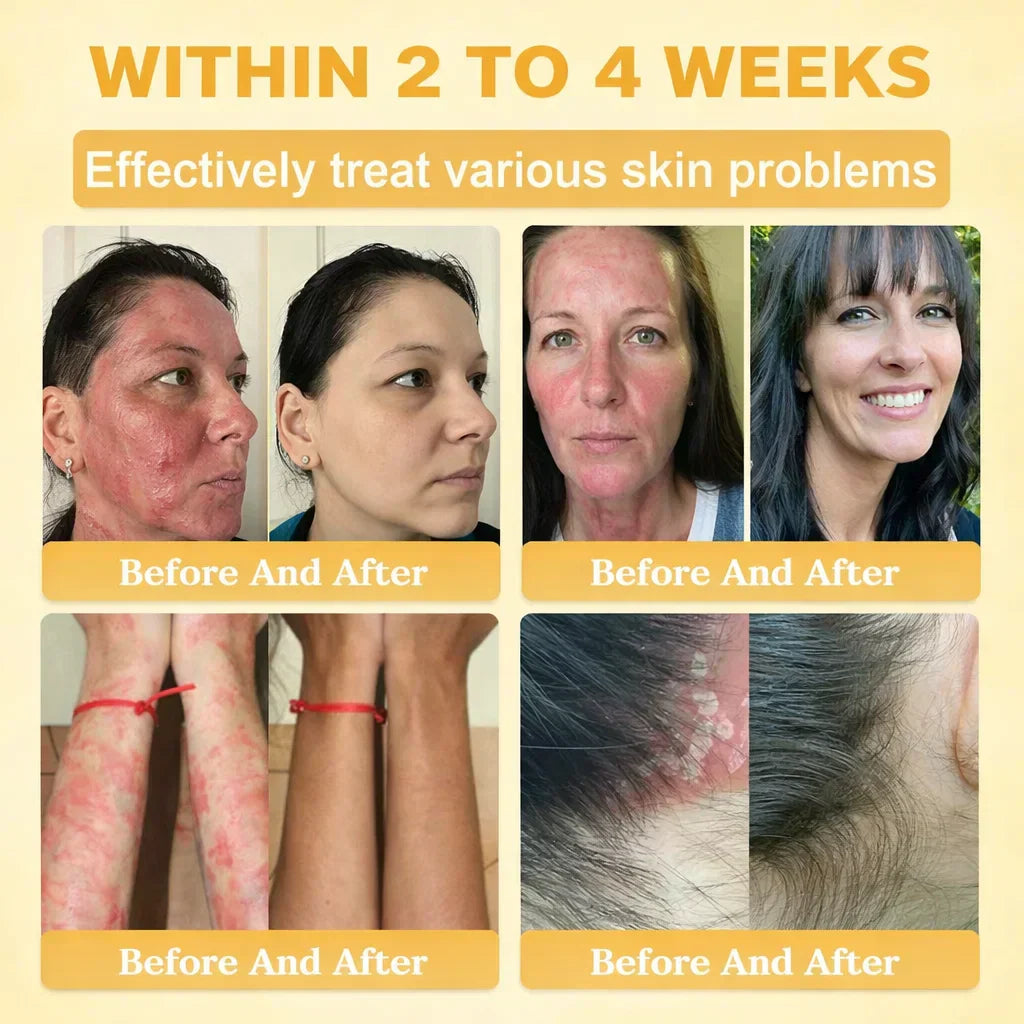 【70% OFF Wraps Up Today】LUMIVO® 🐄Tallow Bee Poison Healing Balm（Sorts Out Spots, Wrinkles & Knackered Skin — Steroid-Free）