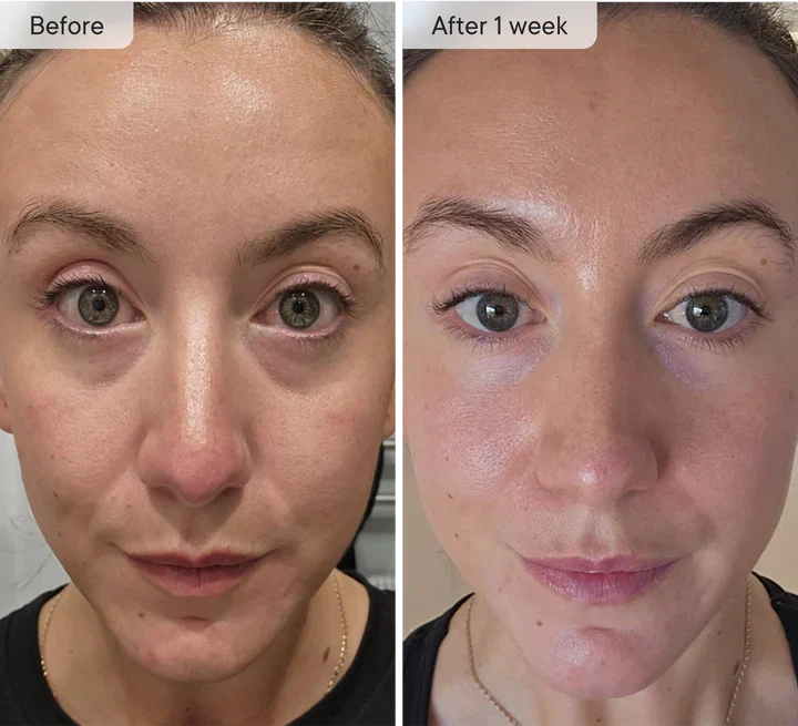 Micro-Infusion Facial Care Patches for Dark Circles, Puffiness, Fine Lines & Wrinkles✅