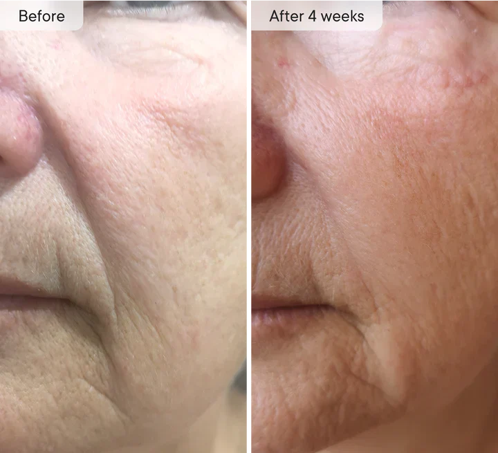 Micro-Infusion Facial Care Patches for Dark Circles, Puffiness, Fine Lines & Wrinkles✅