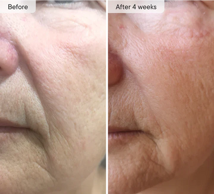 Micro-Infusion Facial Care Patches for Dark Circles, Puffiness, Fine Lines & Wrinkles✅