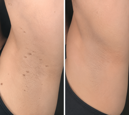✨Lumivo®2-in-1 Microneedle & Hydrocolloid Patch🍀| Removes Raised Moles, Acne, Flat Warts & Skin Tags | Helps Improve Wrinkles, Scars & Blemishes | Invisible Patches for Face & Body