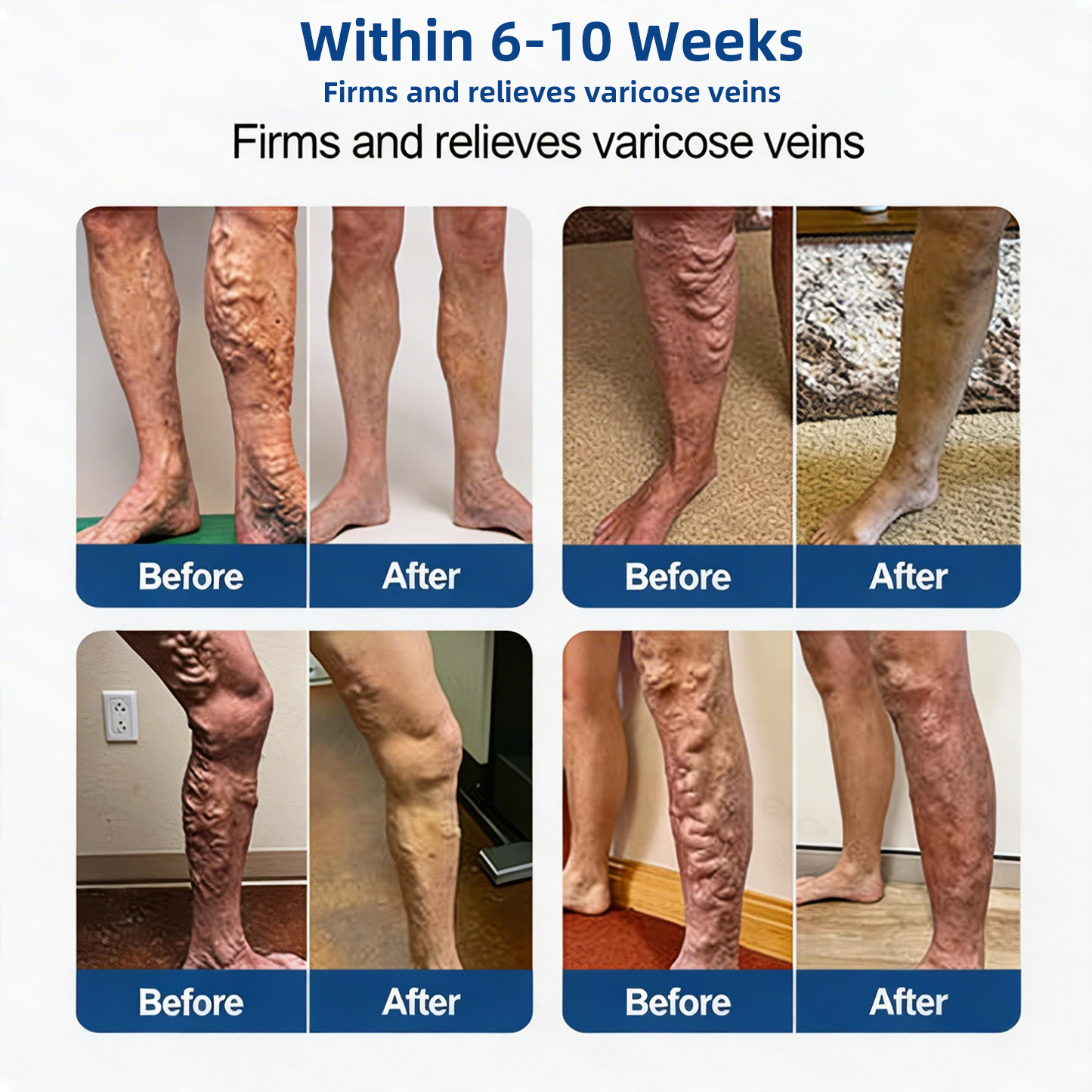 Lumivo® 𝑽𝗲𝗶𝙣 𝘾𝐨𝐧𝘁𝗼𝙪𝙧 𝙈𝙞𝐜𝐫𝒐𝒏𝒆𝗲𝗱𝗹𝙚 𝙋𝙖𝐭𝐜𝒉 𝒘𝒊𝘁𝗵 𝗔𝙙𝙫𝙖𝙣𝙘𝐞𝐝 𝐃𝒊𝒐𝒔𝗺𝙞𝐧 & 𝑯𝒆𝘀𝗽𝗲𝙧𝙞𝙙𝙞𝐧 𝐃𝒆𝒍𝒊𝒗𝗲𝗿𝙮🌿𝟕-𝐃𝐚𝐲 𝐕𝐢𝐬𝐢𝐛𝐥𝐞 𝐑𝐞𝐬𝐮𝐥𝐭𝐬 𝐟𝐨𝐫 𝐕𝐚𝐫𝐢𝐜𝐨𝐬𝐞 𝐕𝐞𝐢𝐧𝐬