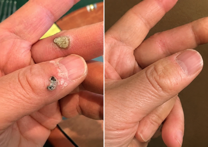 ✨Lumivo®2-in-1 Microneedle & Hydrocolloid Patch🍀| Removes Raised Moles, Acne, Flat Warts & Skin Tags | Helps Improve Wrinkles, Scars & Blemishes | Invisible Patches for Face & Body