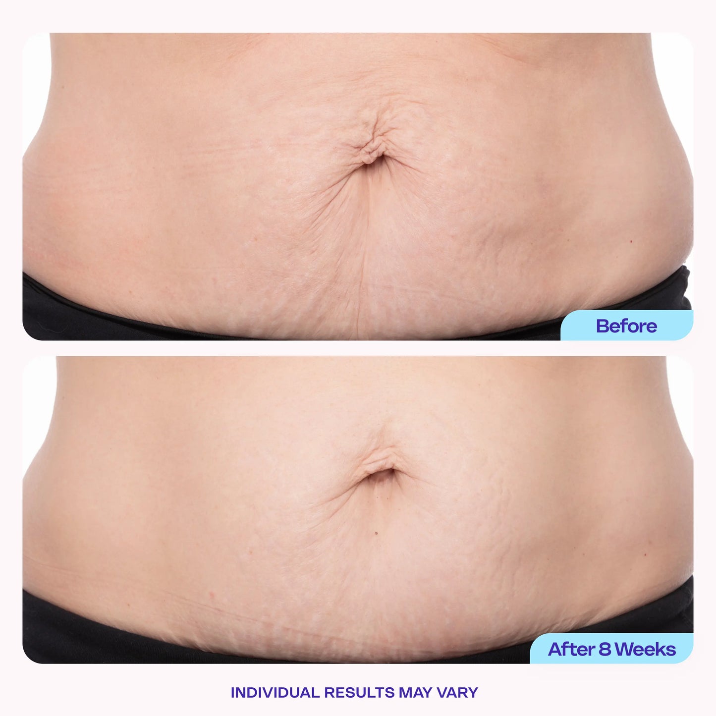 LUMIVO Tighten & Smooth Belly Firming Cream-🎁Limited Time Offer with 40% Discount! 🎁